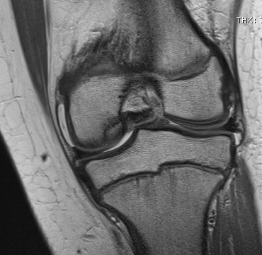 Knee OCD MRI Cartilage Intact
